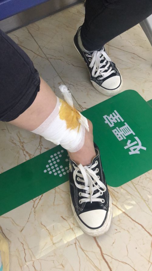 没注意突然被一只流浪狗咬到小腿处