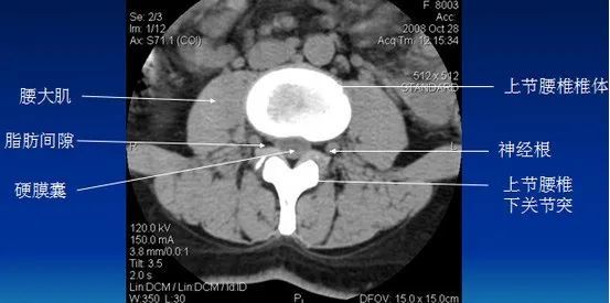 基础入门|腰椎ct诊断:椎间盘突出,椎管狭窄,退行性改变