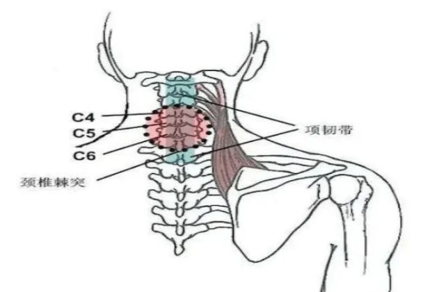 頸椎棘突應激點多見於棘上韌帶,亦稱項韌帶,顯性應激點常見於頸椎3,4