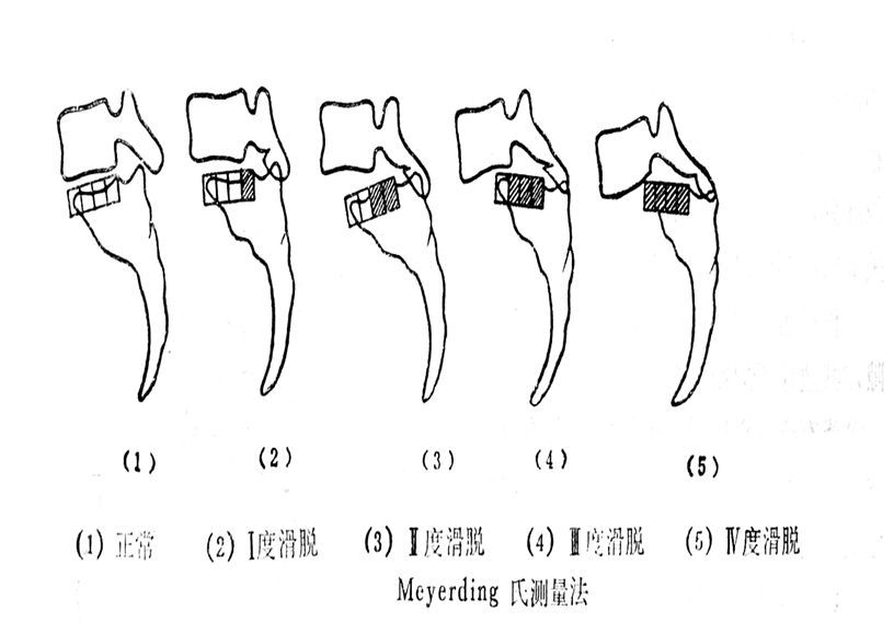 腰椎滑脫的影像及臨床表現