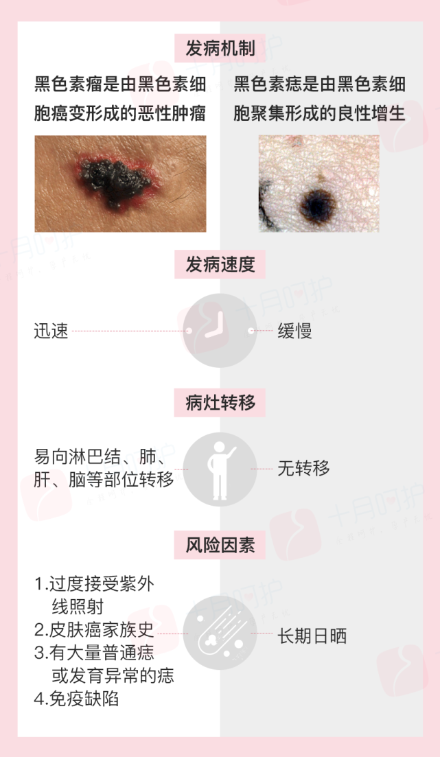 身上这4个部位长痣了,一定要重视起来|细胞|黑色素瘤|色素痣|癌变