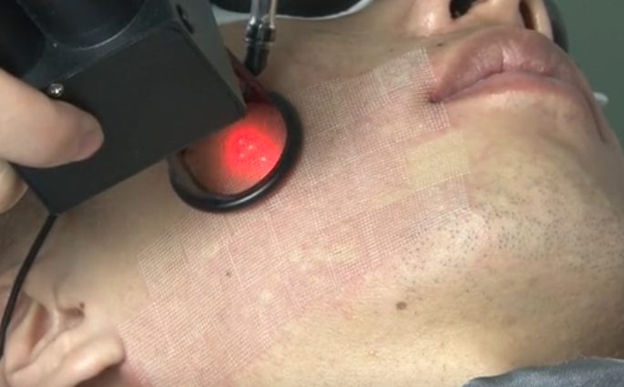 医美科普光子嫩肤点阵激光去黑激光去红激光等术后护理注意事项