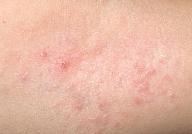 牛皮癣症状介绍