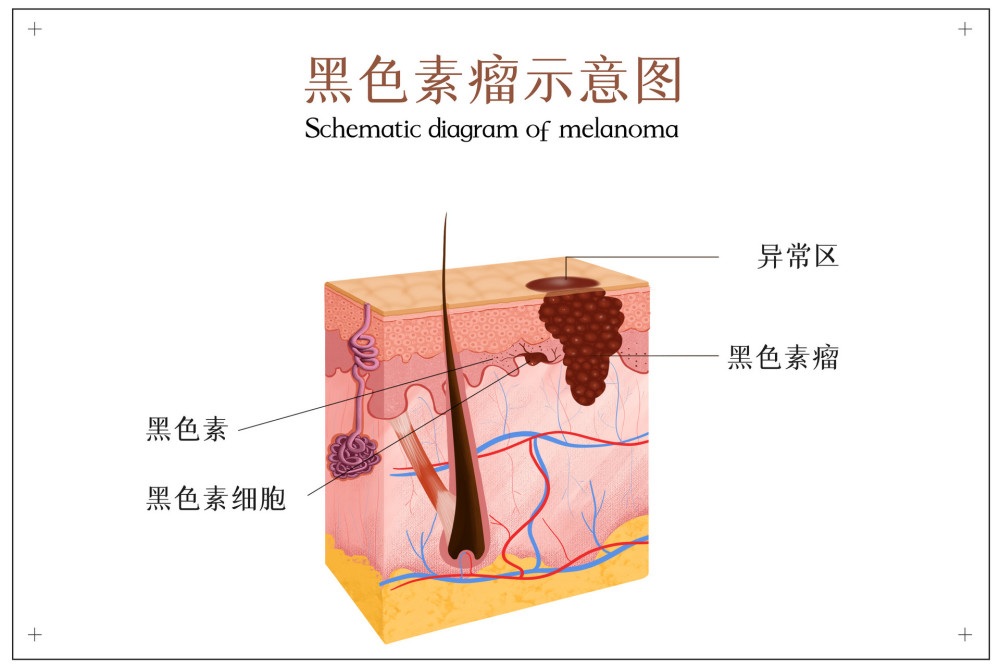 這樣的痣要當心可能是惡性黑色素瘤醫生不要扣會威脅健康