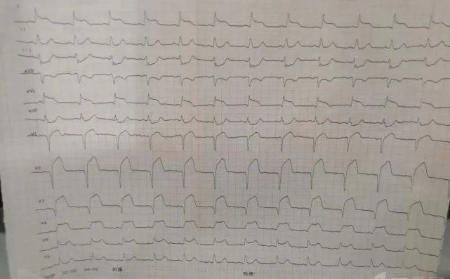 st 段抬高6上述 t 波特徵性改變當心絞痛再次發作之後,可以重複,提示