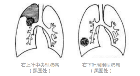 肺癌吐灰色痰图片