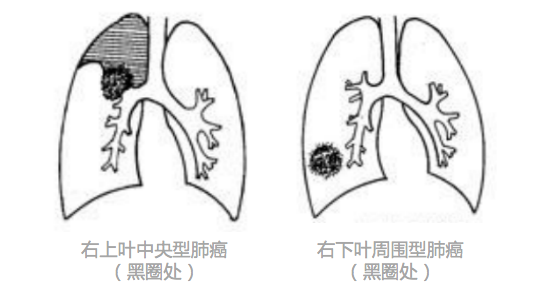 這類肺癌的 中央有遮擋,比如食管,氣管,脊柱等擋住視野,而且中