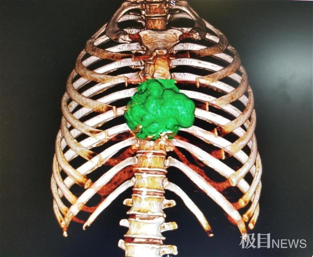 巨大肿瘤吃了胸骨军医巧施妙手助患者重新挺起胸膛