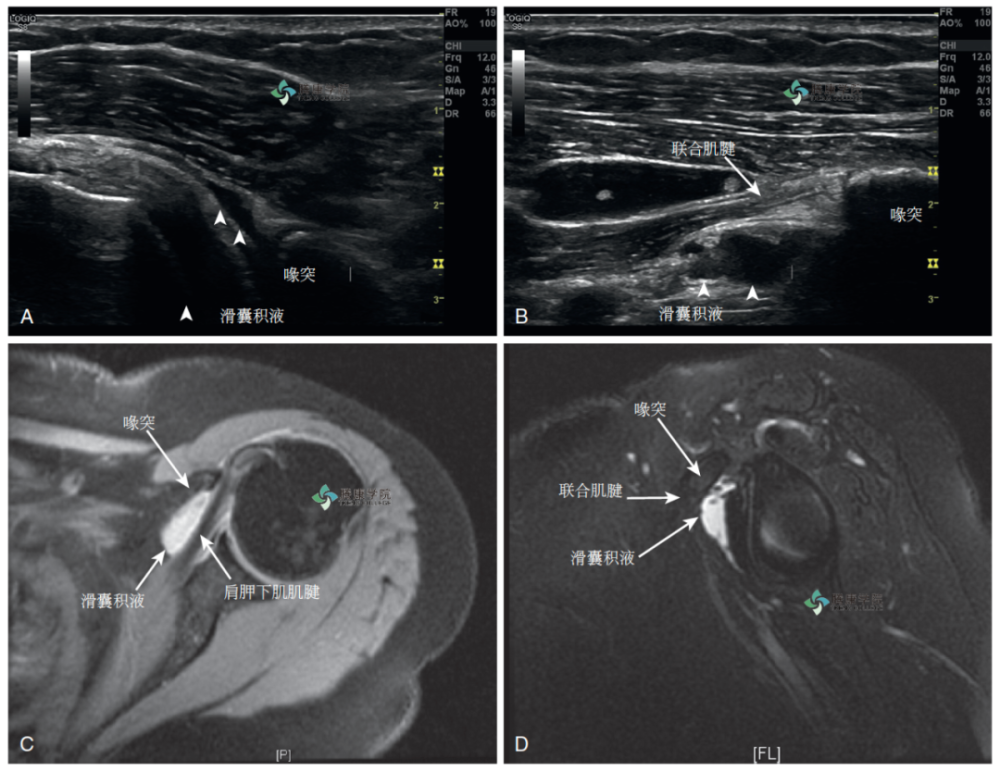 疼痛解剖学喙突下滑囊炎内收释放试验