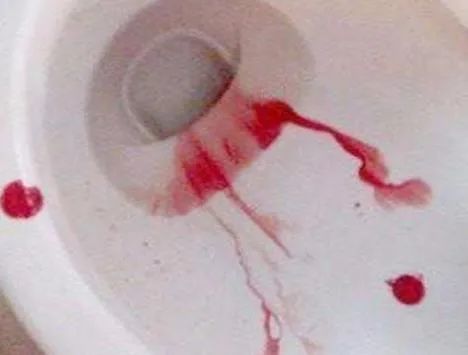 评测痔疮便血有肉球而发愁吗学会这三招让你无痔一身轻