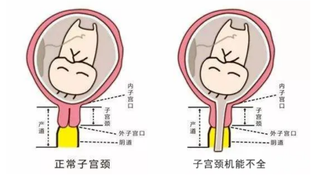 宮頸機能不全,也叫宮頸內口鬆弛症,主要表現為無宮縮(即無痛性)的情況