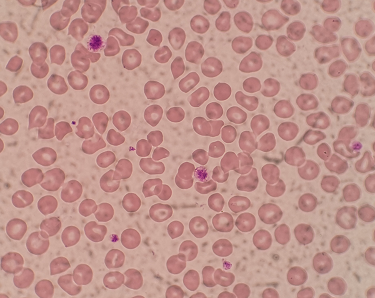 虚惊一场的血小板危急值