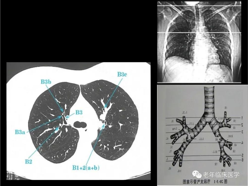珍藏版ct系列之一肺ct基础篇