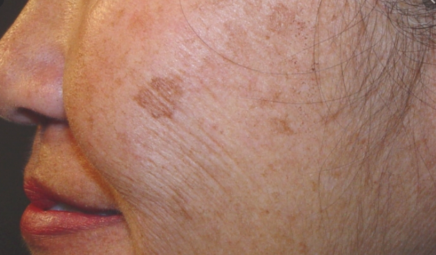 别不信,年轻人也会长老年斑……还好可以这么解决它!