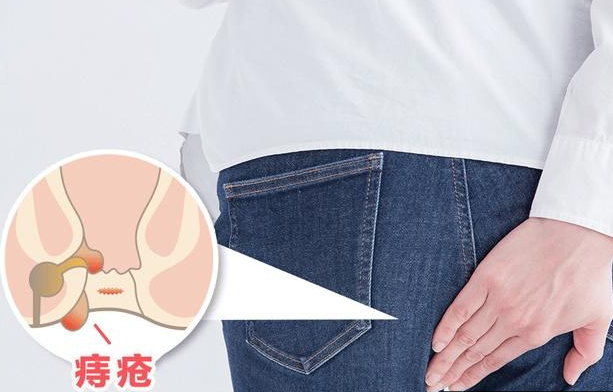 有痔疮会是什么样的感觉?