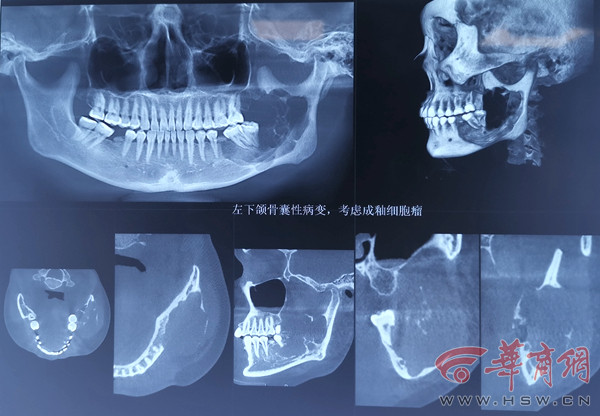 术前口腔ct术后口腔ct为了满足后期牙种植的需求,植入的腓骨还进行了