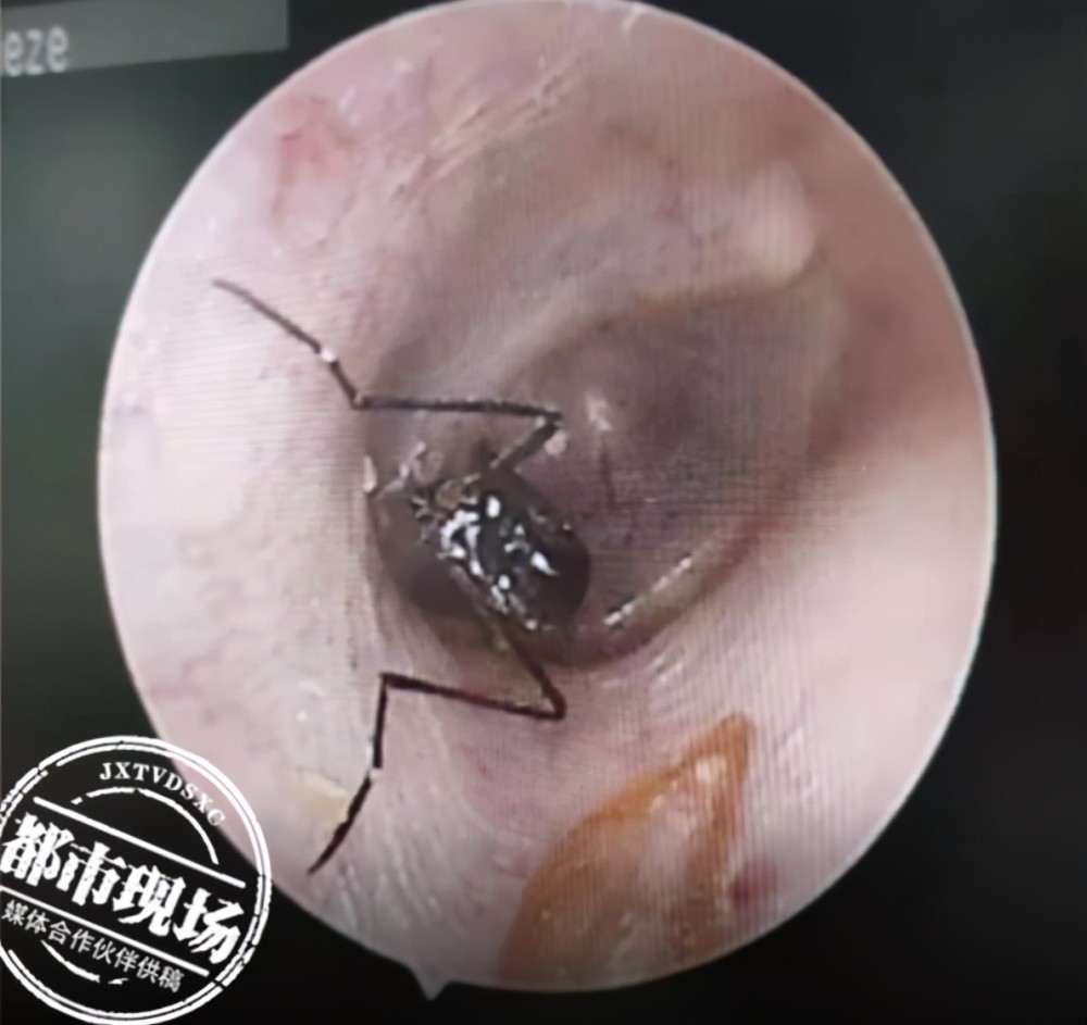 那么万一有虫子钻进耳朵该怎么办呢?来听医生是怎么说的.