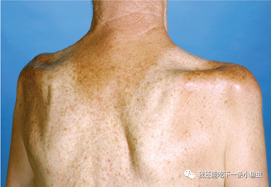 对称性上肢近端肌萎缩导致手臂上抬受限(如桶人综合征或连枷臂综合征)