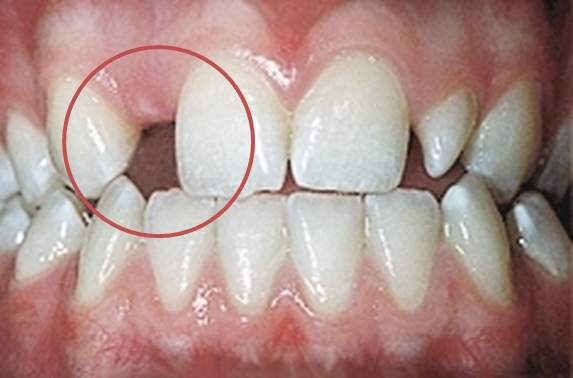 一颗牙齿长歪了的牙齿,每次刷牙都不能清洁到位,怎么办