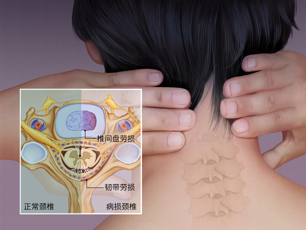 局部型颈椎病,是指具有头,肩,颈,臂的疼痛及相应的压痛点,表现为颈项