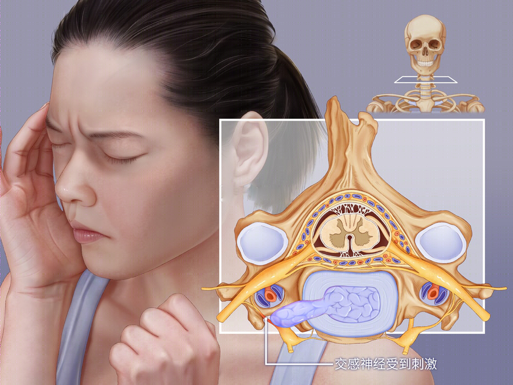 交感神经型颈椎病(1)临床表现为头晕,眼花,耳鸣,手麻,心动过速,心前