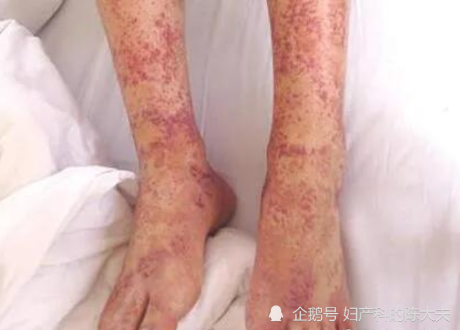 血小板减少性紫癜 腾讯网