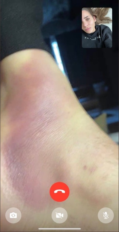 心疼女友晒巴尔韦德脚踝受伤图大面积红肿令人担忧