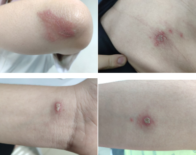 当毒隐翅虫身体被挤破时,体内会流出强酸性(ph1-2,其ph值相当于浓硫酸