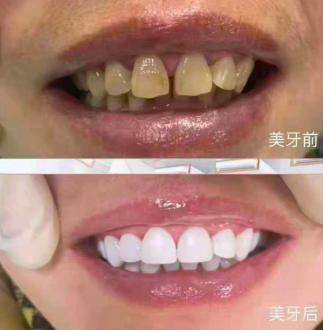 3清洁困难,牙龈出血发炎此外,经过"美牙师"贴片后,牙齿大多连成了一片