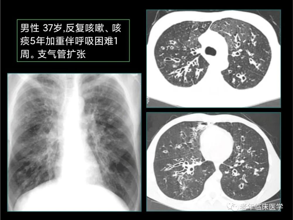 珍藏版ct系列之二肺部炎症性疾病