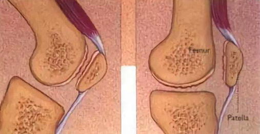 揭秘髌骨软化症的 5 个误区_腾讯新闻