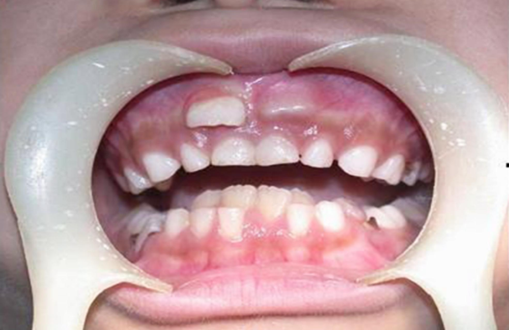7岁男童因多生牙拔牙昏迷40天难道父母不该好好反思下么