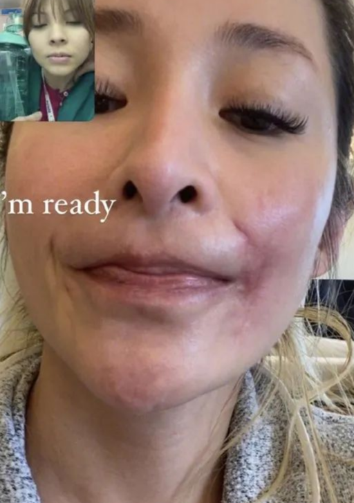 萧亚轩被狗咬伤之后首露面!脸部伤疤十分明显,自曝脸细胞坏死