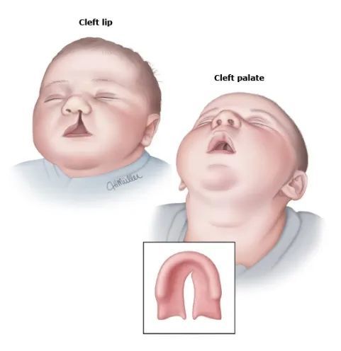 兔唇宝宝:我和所有人都不一样,但和所有人都一样