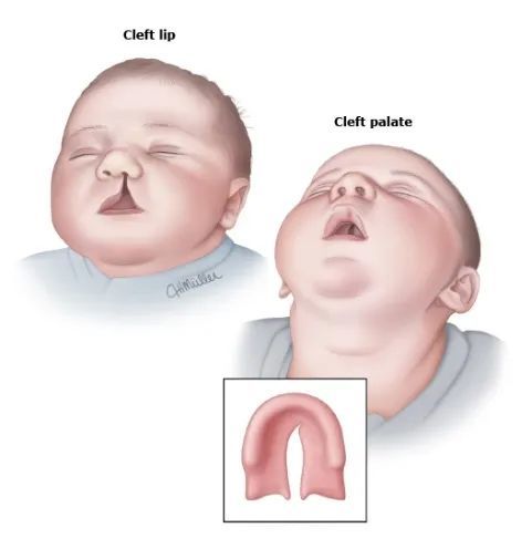 宝宝上腭裂图片图片