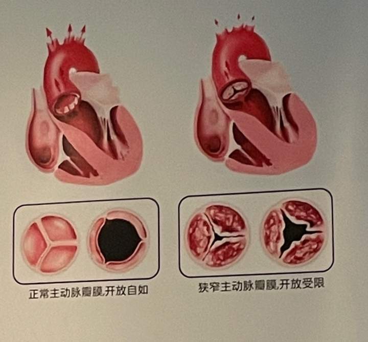 果然,老太太的心臟主動脈瓣重度狹窄伴中度關閉不全