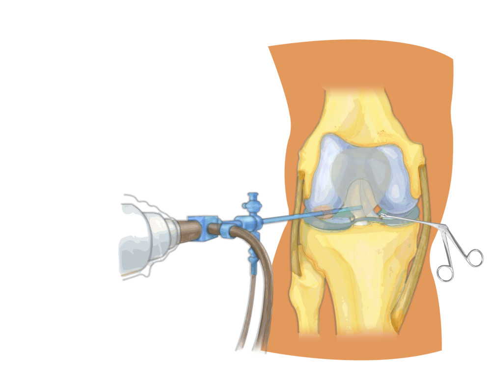我们可以把破裂的半月板进行部分切除,或者是尝试进行缝合,患者的疼痛