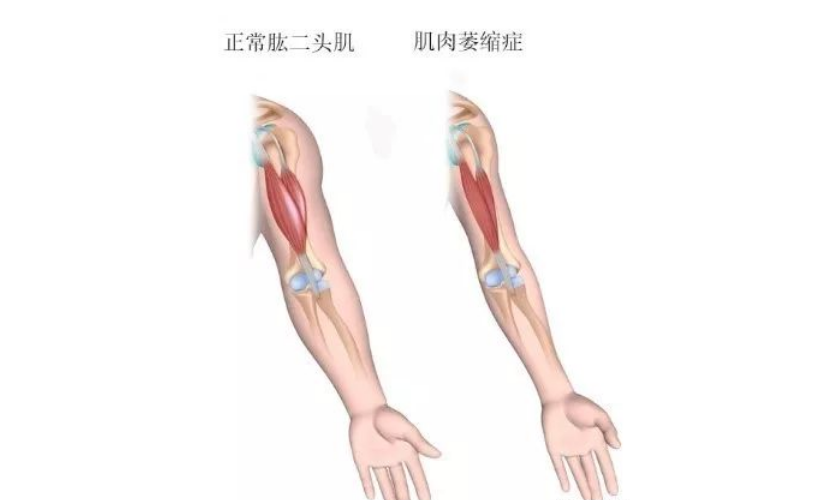 卢老促谈怎么预防肌肉继续萎缩 如何进行锻炼才有效呢 腾讯新闻