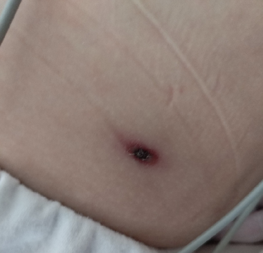 患儿持续高热一周,竟和小虫子有关?