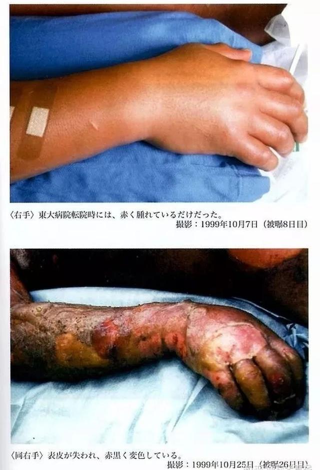 第三个就是核辐射导致细胞中的染色体受损而产生了大量的基因突变.