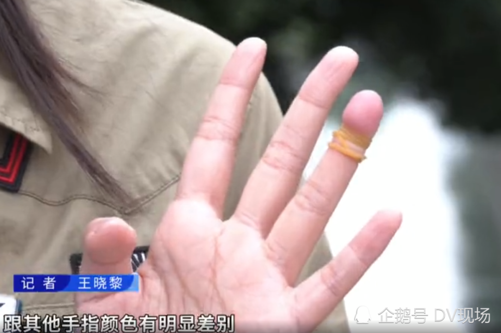 女童睡觉时把皮筋缠在手指上忘了取下,指头黑紫险截肢_腾讯新闻