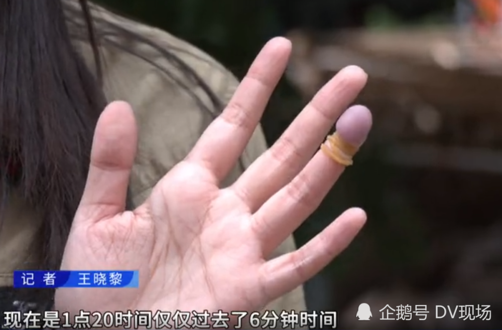 6小时以后就可能出现一些不可逆的坏死,但手指一般不能超过8个小时或