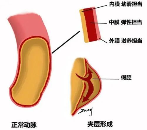 头颈部动脉夹层 了解一下 腾讯新闻