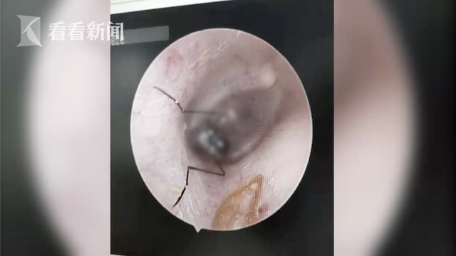 吓惨女子耳朵疼痛难忍一夜难眠医生竟从里面取出一只