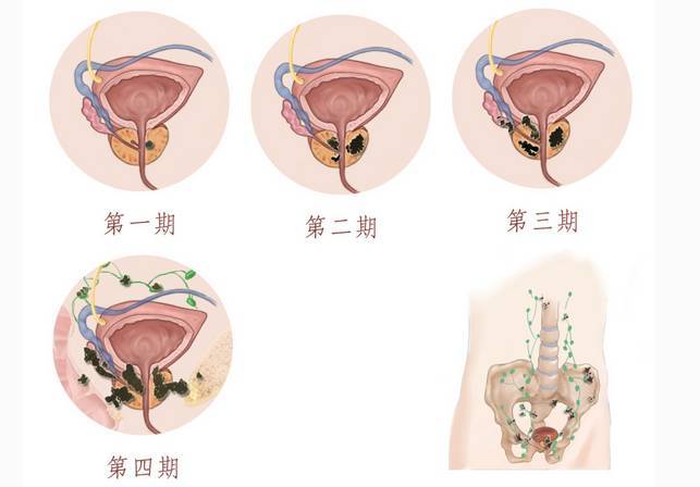 張廣生主任前列腺癌和膀胱癌的生存率