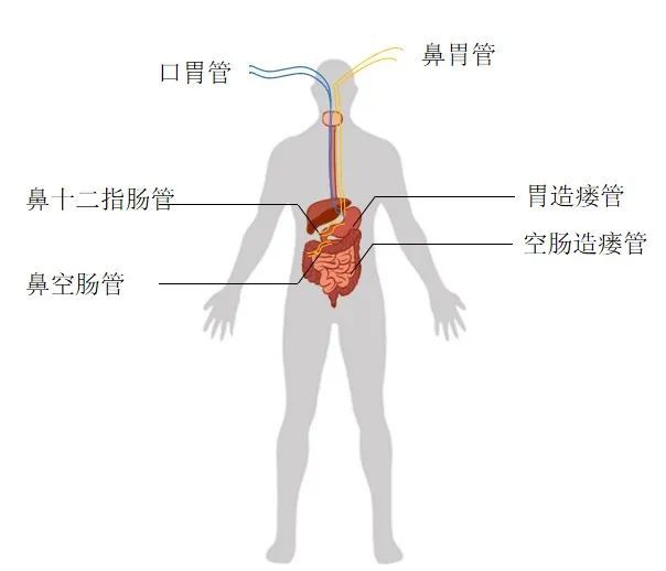 营养支持的首要手段,其主要途径有鼻胃管,鼻肠管,经皮内镜下胃造瘘管
