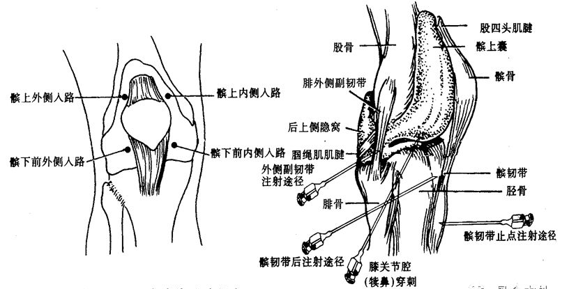 膝关节腔内注射操作:方法:用指甲定位好后,消毒患处,针头与胫骨平台