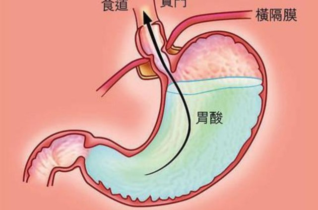 时不时胃酸烧心难受可能就是这个原因你是否也中招了呢