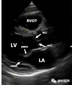 多圖片解讀超聲心動圖瓣膜分佈乾貨滿滿快來收藏