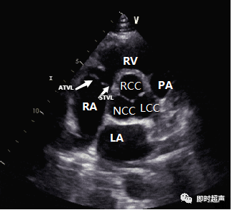 多图片解读超声心动图瓣膜分布,干货满满,快来收藏!